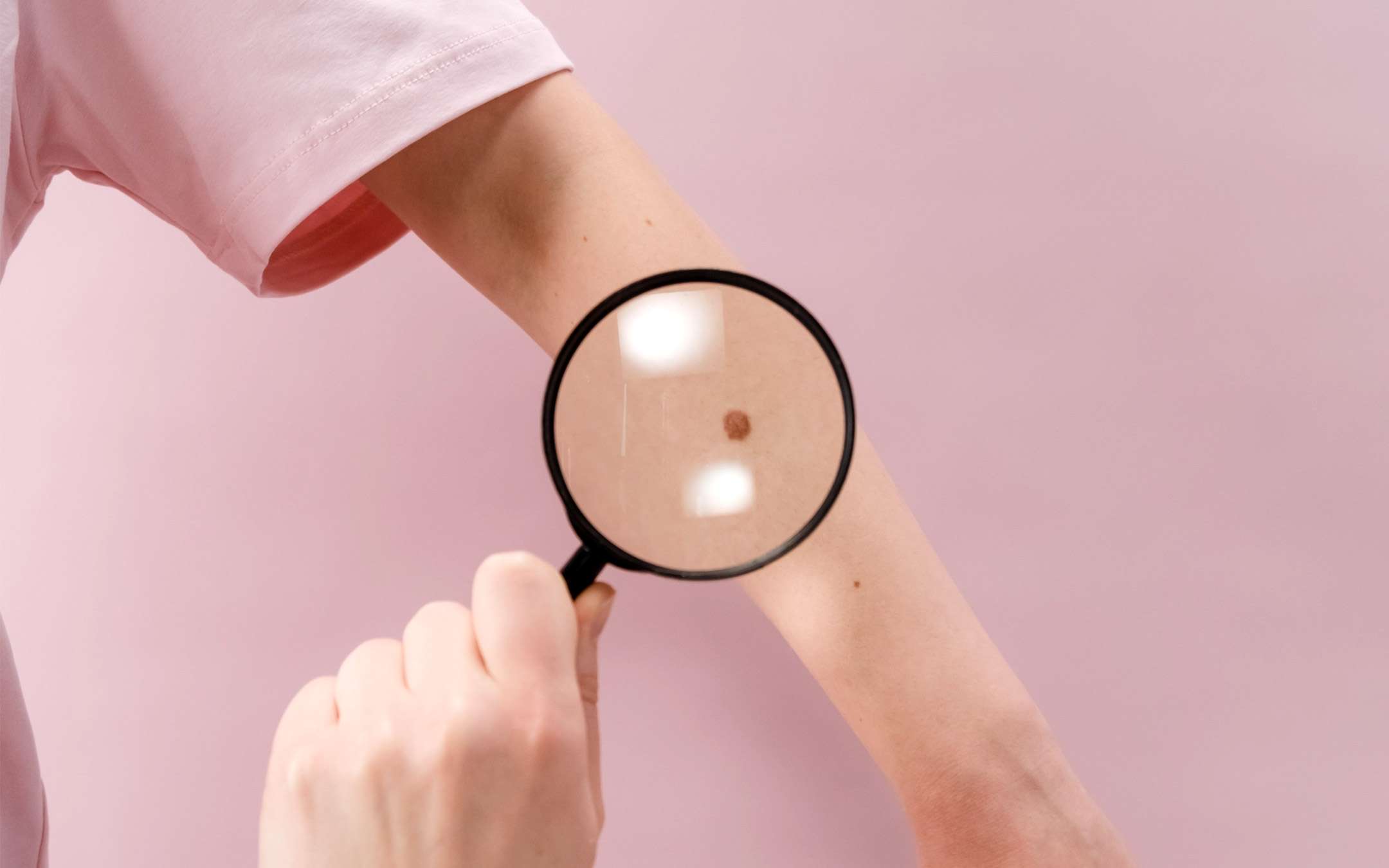 An AI for the accurate diagnosis of melanoma An AI for the accurate diagnosis of melanoma