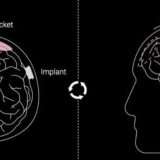 Neuralink, chip modificato per il secondo paziente