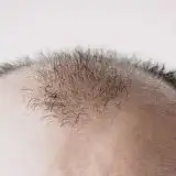 Perdita di capelli? Lo zucchero potrebbe essere la soluzione