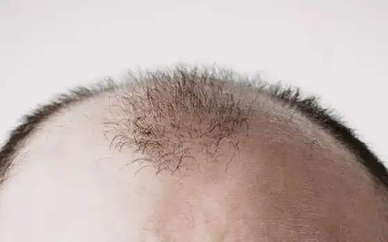 Perdita di capelli? Lo zucchero potrebbe essere la soluzione