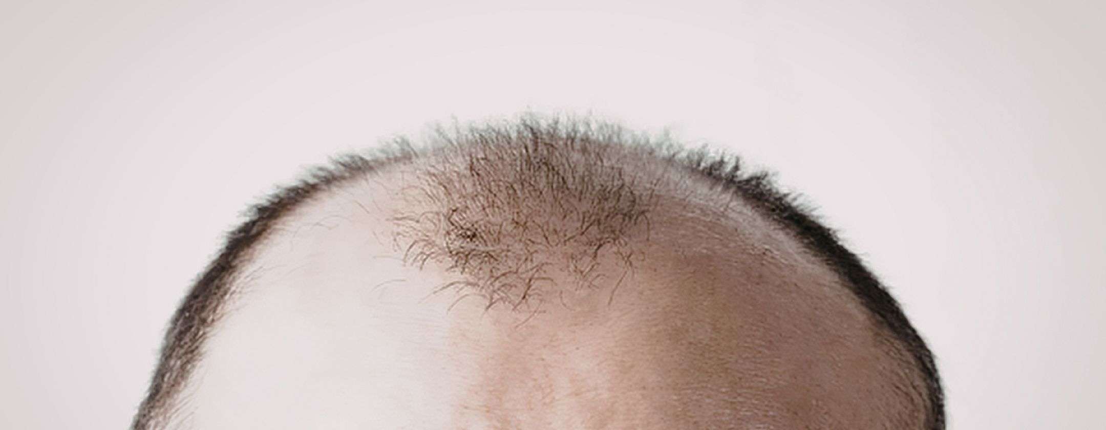 perdita-capelli-zucchero-potrebbe-essere-soluzione