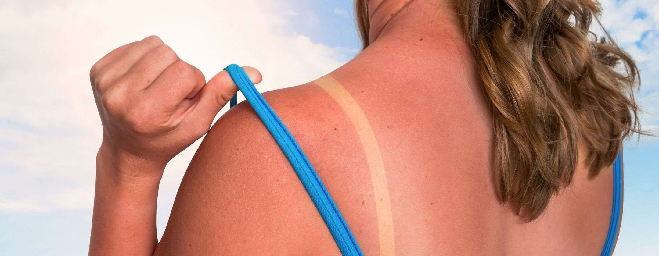 una-sola-scottatura-solare-puo-cambiare-per-sempre-la-tua-salute